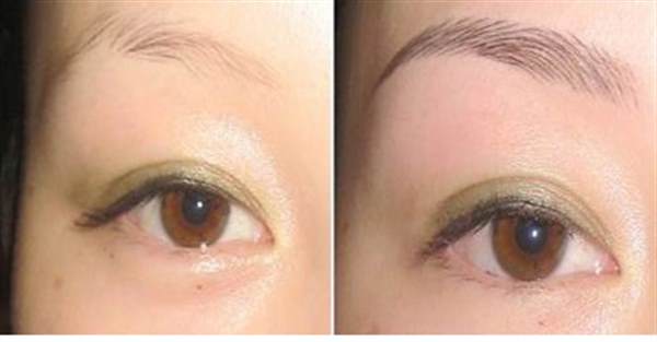 提眉手術恢復過程圖效果對比