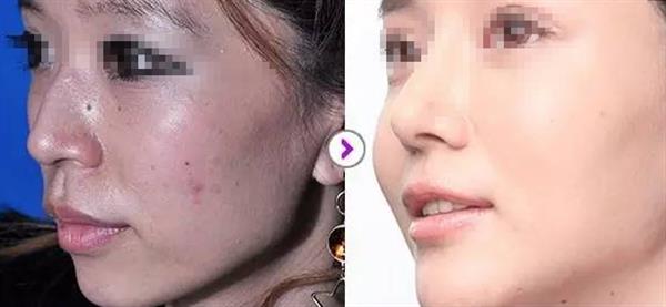 假體<a href=http://m.f3bb6.cn/listinfo-737-0.html target=_blank class=infotextkey>隆鼻</a>術(shù)后要多久恢復(fù)呢