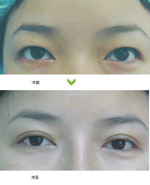 韓式小切口多久能恢復(fù)