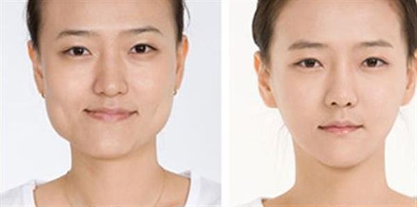 下額角磨骨風險大嗎