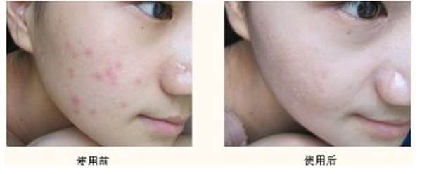 封閉性粉刺怎么去除