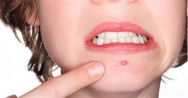 臉上長粉刺如何去除