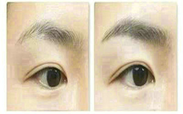 <a href=http://m.f3bb6.cn/listinfo-655-0.html target=_blank class=infotextkey>切眉</a>后多久恢復自然?