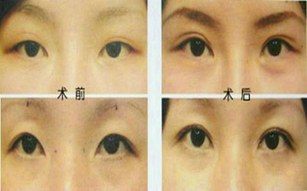 <a href=http://m.f3bb6.cn/listinfo-655-0.html target=_blank class=infotextkey>切眉</a>后多久可以<a href=http://m.f3bb6.cn/listinfo-657-0.html target=_blank class=infotextkey>繡眉</a>?