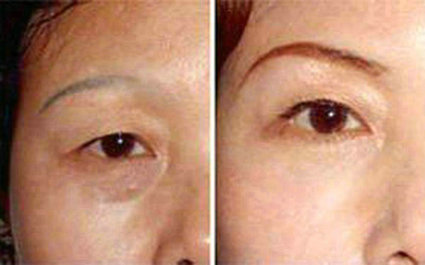 <a href=http://m.f3bb6.cn/listinfo-655-0.html target=_blank class=infotextkey>切眉</a>后多久能恢復?