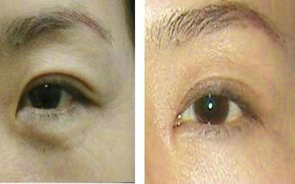 <a href=http://m.f3bb6.cn/listinfo-655-0.html target=_blank class=infotextkey>切眉</a>恢復期