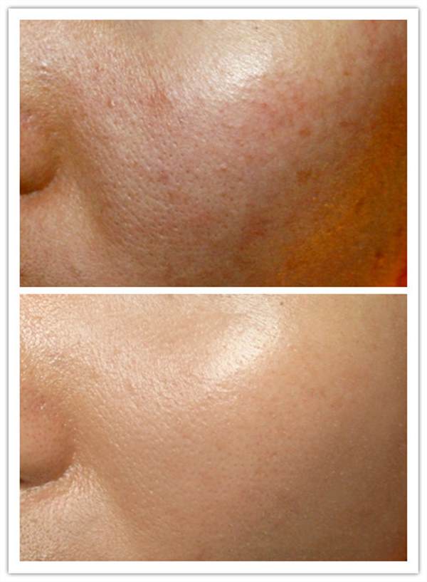 <a href=http://m.f3bb6.cn/listinfo-779-0.html target=_blank class=infotextkey>治療痤瘡</a>大概花多少錢