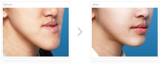 <a href=http://m.f3bb6.cn/listinfo-641-0.html target=_blank class=infotextkey>地包天矯正</a>方法有哪些