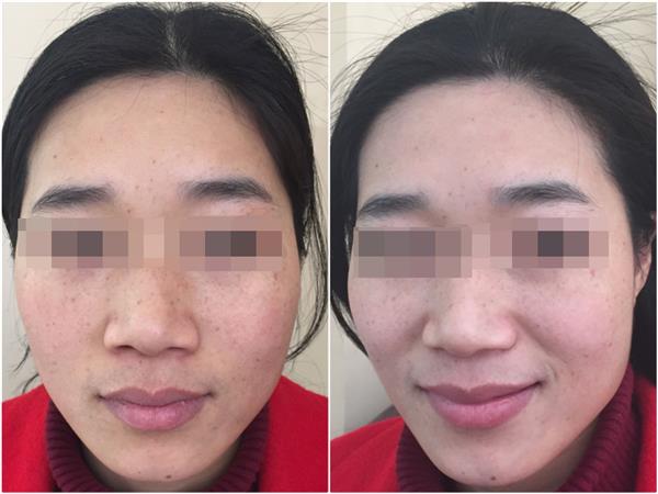 果酸換膚和光子<a href=http://m.f3bb6.cn/listinfo-770-0.html target=_blank class=infotextkey>嫩膚</a>術后分別要如何護理