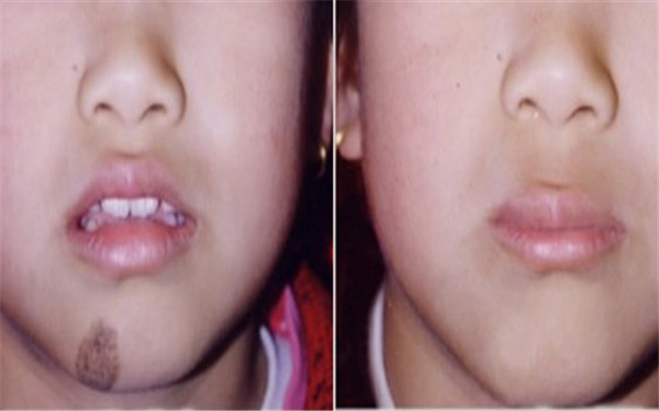 <a href=http://m.f3bb6.cn/listinfo-773-0.html target=_blank class=infotextkey>去胎記</a>的費用是多少