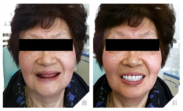 國產種植牙是什么價格?