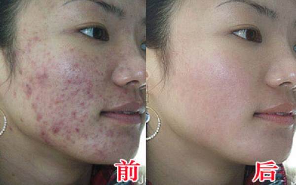 怎樣祛除痘印