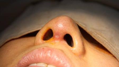 鼻子假體取出后的照片