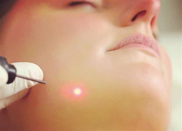 激光<a href=http://m.f3bb6.cn/listinfo-797-0.html target=_blank class=infotextkey>去痘疤</a>多久恢復(fù)