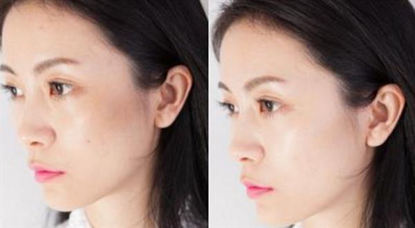 黑頭粉刺怎么去除較好