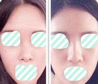 膨體<a href=http://m.f3bb6.cn/listinfo-737-0.html target=_blank class=infotextkey>隆鼻</a>手術具備的優點