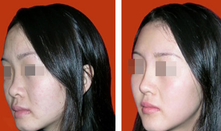 自體脂肪<a href=http://m.f3bb6.cn/listinfo-737-0.html target=_blank class=infotextkey>隆鼻</a>前后