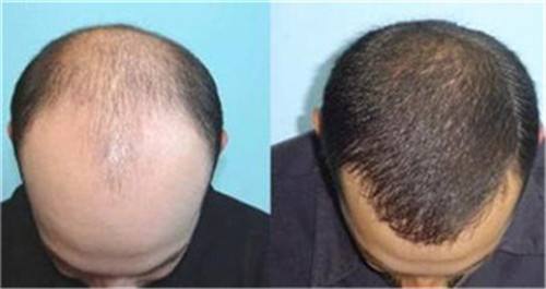 種植頭發的價格