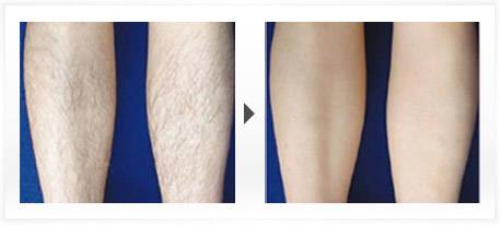 何為光子<a href=http://m.f3bb6.cn/listinfo-670-0.html target=_blank class=infotextkey>脫毛</a>技術