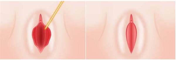 大陰唇整形容易成功嗎