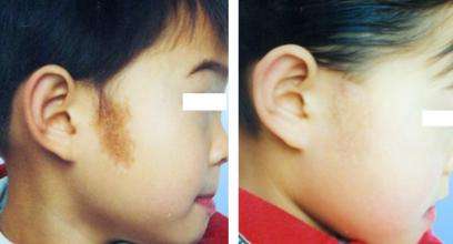 黑色胎記能徹底去除嗎