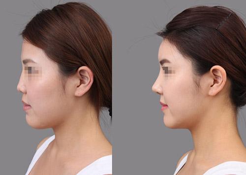 鼻梁打一針多少錢