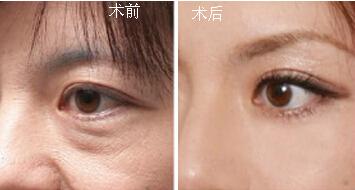 提眉術后要怎么防止感染呢？