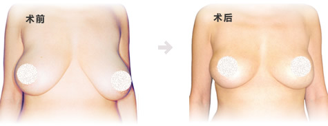 深圳胸下垂手術疤痕圖片