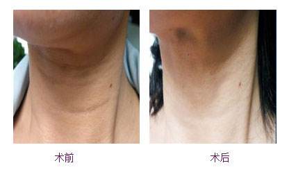 怎樣去除脖子上的頸紋