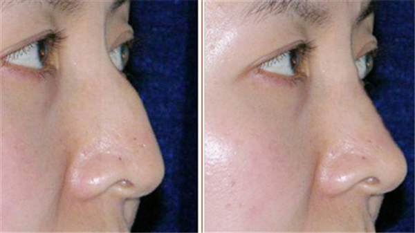 <a href=http://m.f3bb6.cn/listinfo-756-0.html target=_blank class=infotextkey>駝峰鼻矯正</a>是大手術嗎