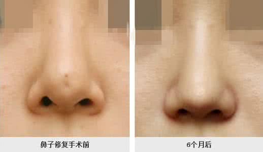 硅膠<a href=http://m.f3bb6.cn/listinfo-737-0.html target=_blank class=infotextkey>隆鼻</a>排異圖片