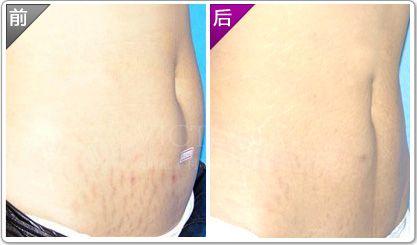 有什么辦法<a href=http://m.f3bb6.cn/listinfo-791-0.html target=_blank class=infotextkey>去妊娠紋</a>