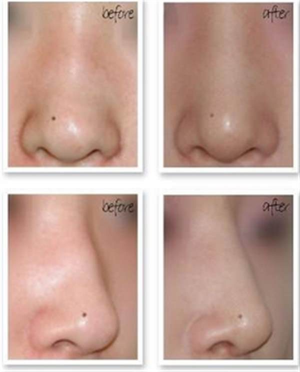 肋軟骨<a href=http://m.f3bb6.cn/listinfo-737-0.html target=_blank class=infotextkey>隆鼻</a>修復(fù)多少錢