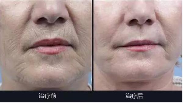 成都采光<a href=http://m.f3bb6.cn/listinfo-770-0.html target=_blank class=infotextkey>嫩膚</a>的原理是什么