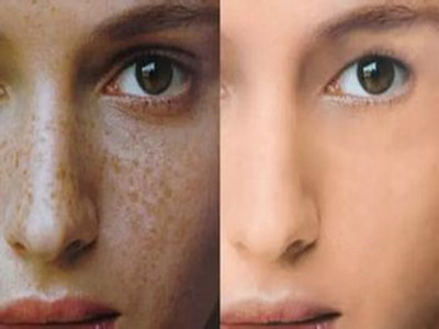 激光去除雀斑的方法