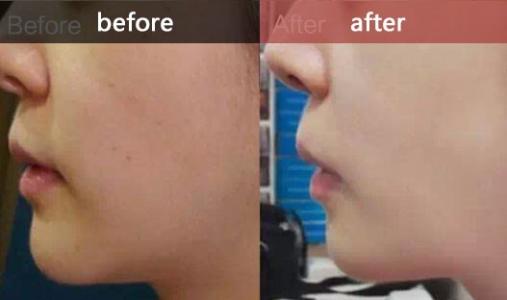 水光<a href=http://m.f3bb6.cn/listinfo-770-0.html target=_blank class=infotextkey>嫩膚</a>多久打一次