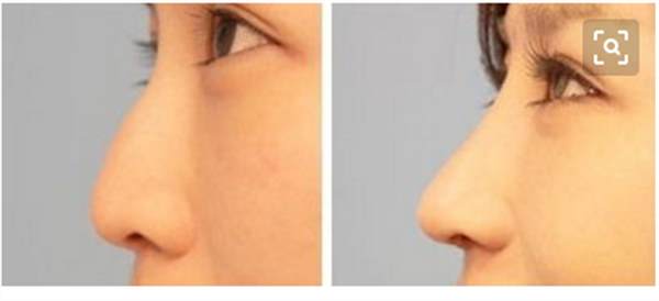 注射<a href=http://m.f3bb6.cn/listinfo-737-0.html target=_blank class=infotextkey>隆鼻</a>效果怎么樣呢