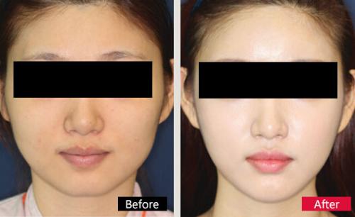 水光<a href=http://m.f3bb6.cn/listinfo-770-0.html target=_blank class=infotextkey>嫩膚</a>恢復期多久恢復