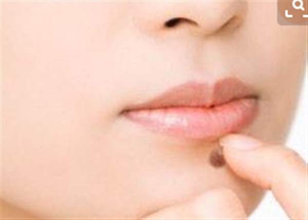 激光去痣后的注意事項有哪些