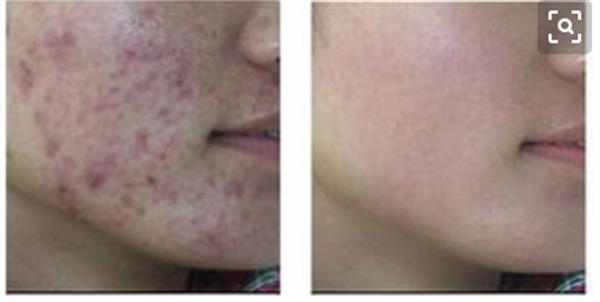 彩光<a href=http://m.f3bb6.cn/listinfo-770-0.html target=_blank class=infotextkey>嫩膚</a><a href=http://m.f3bb6.cn/listinfo-775-0.html target=_blank class=infotextkey>去粉刺</a>的效果與哪些因素有關