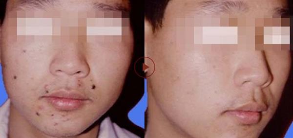 怎么<a href=http://m.f3bb6.cn/listinfo-767-0.html target=_blank class=infotextkey>祛痣</a>