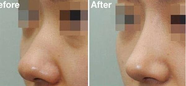 假體<a href=http://m.f3bb6.cn/listinfo-737-0.html target=_blank class=infotextkey>隆鼻</a>需要注意的哪些事項