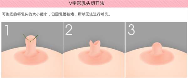 什么是乳頭<a href=http://m.f3bb6.cn/listinfo-625-0.html target=_blank class=infotextkey>乳暈縮小</a>術