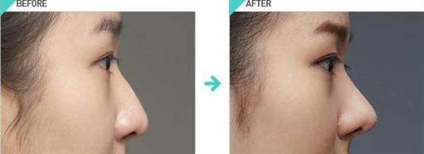 假體<a href=http://m.f3bb6.cn/listinfo-737-0.html target=_blank class=infotextkey>隆鼻</a>后會不會有后遺癥發生