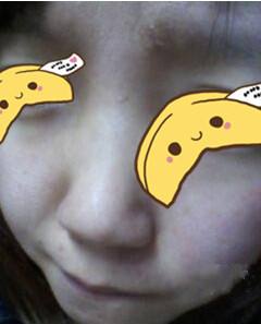 紅寶石激光點痣價格