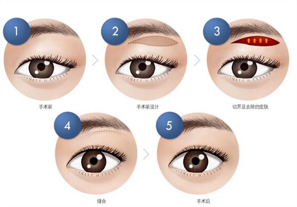 <a href=http://m.f3bb6.cn/listinfo-655-0.html target=_blank class=infotextkey>切眉</a>會留下疤痕嗎