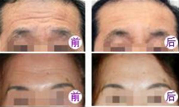 男士<a href=http://m.f3bb6.cn/listinfo-765-0.html target=_blank class=infotextkey>去抬頭紋</a>的好方法