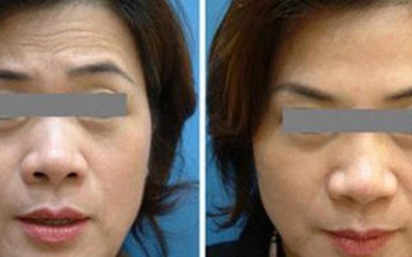 抬頭紋嚴重怎么辦