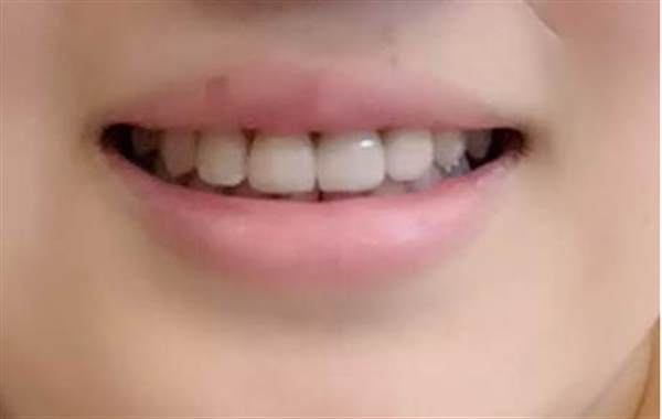 <a href=http://m.f3bb6.cn/listinfo-825-0.html target=_blank class=infotextkey>牙齒種植</a>后的注意事項有哪些