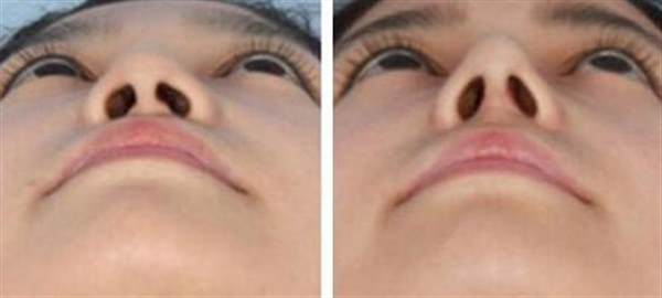 如何讓鼻子側肉變小